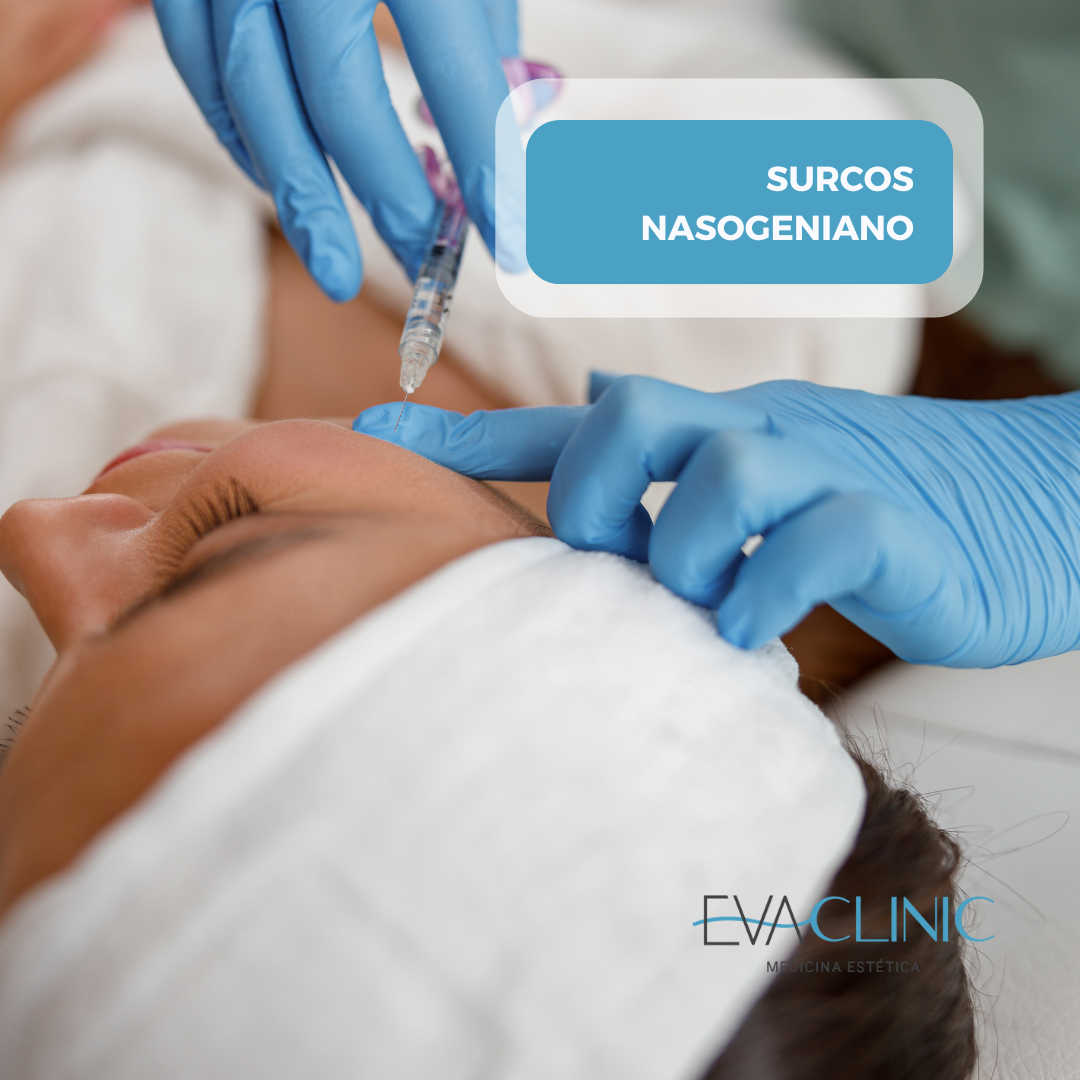 SURCOS NASOGENIANOS