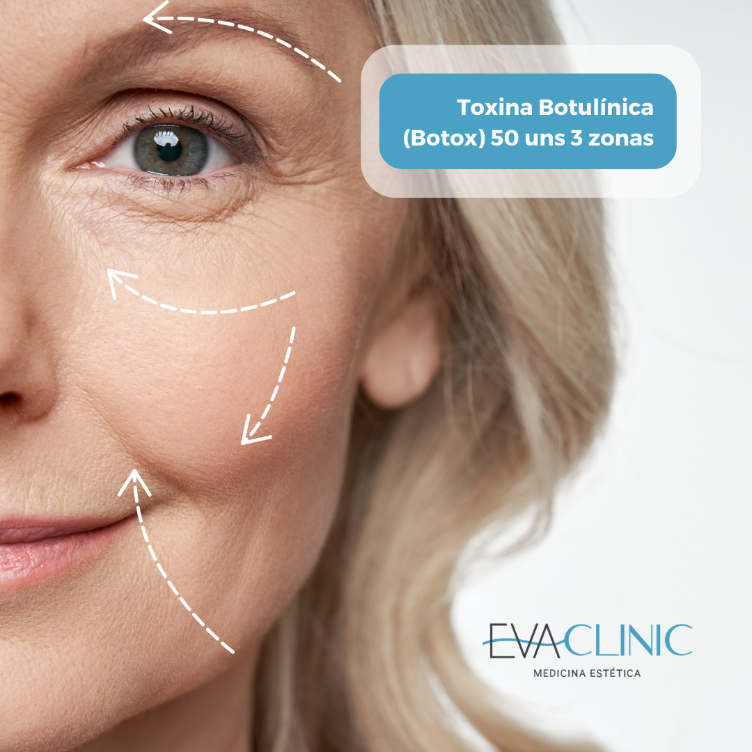 Toxina Botulínica (Botox) 50 unds 3 zonas