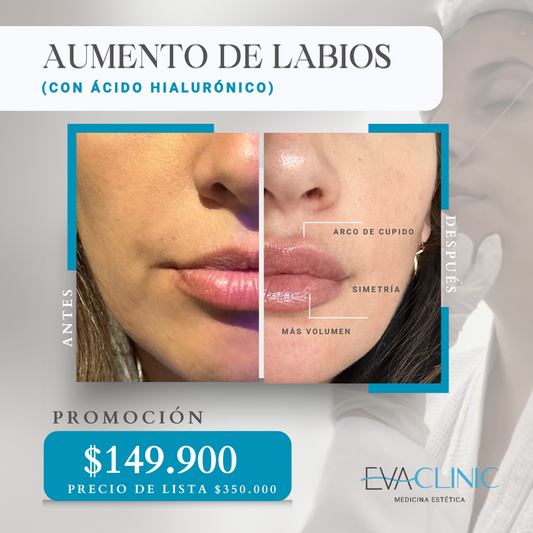 AUMENTO DE LABIOS